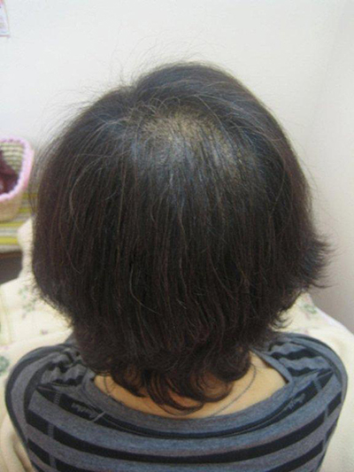 ヘアジェンヌ増毛法 施術例2 400本施術後